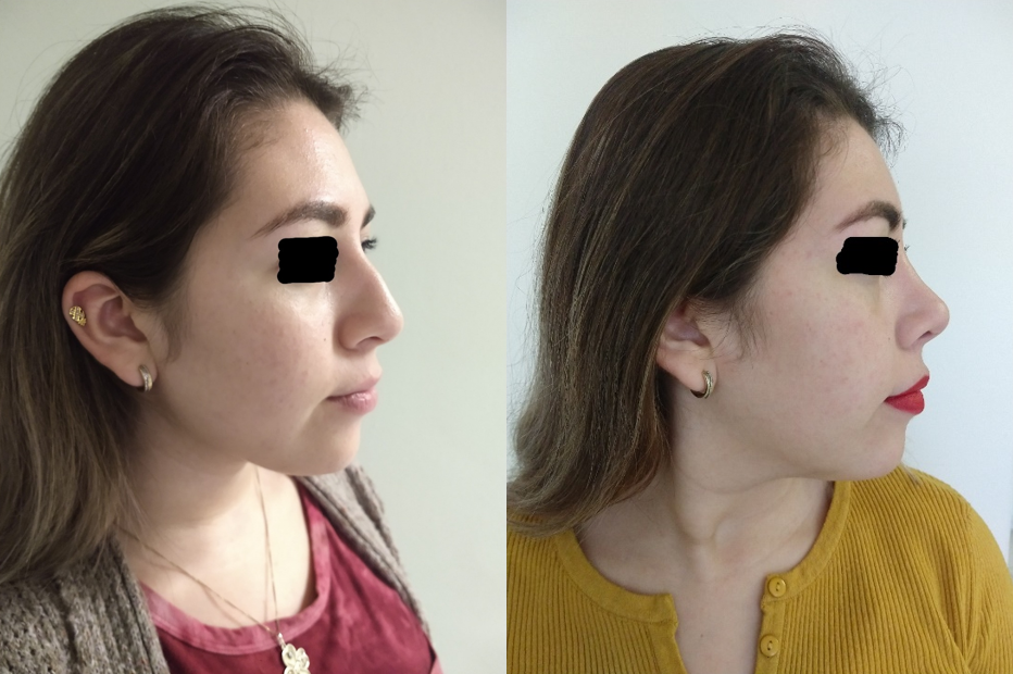 Resultado Rinoplastia 1