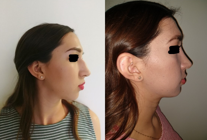 Resultado Rinoplastia 10