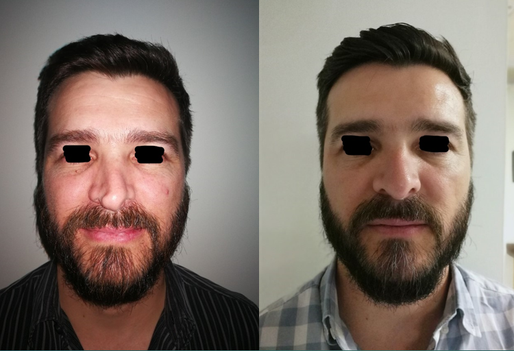 Resultado Rinoplastia 11