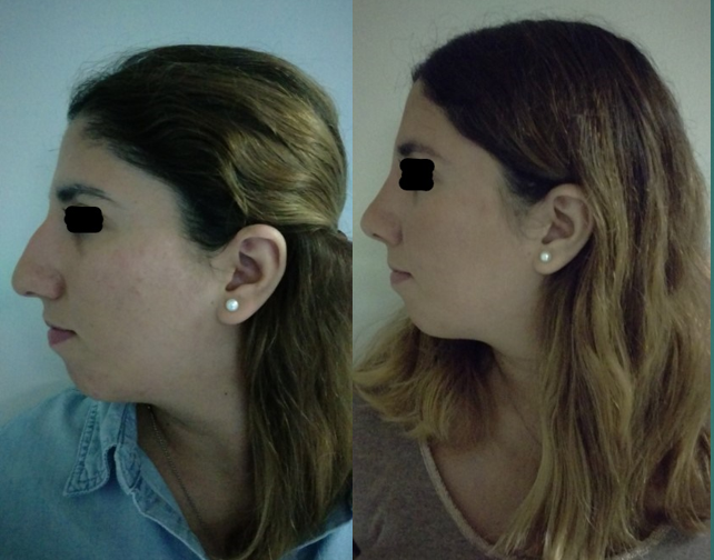 Resultado Rinoplastia 12