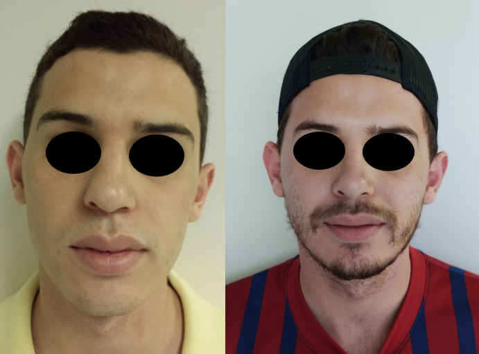 Resultado Rinoplastia 14