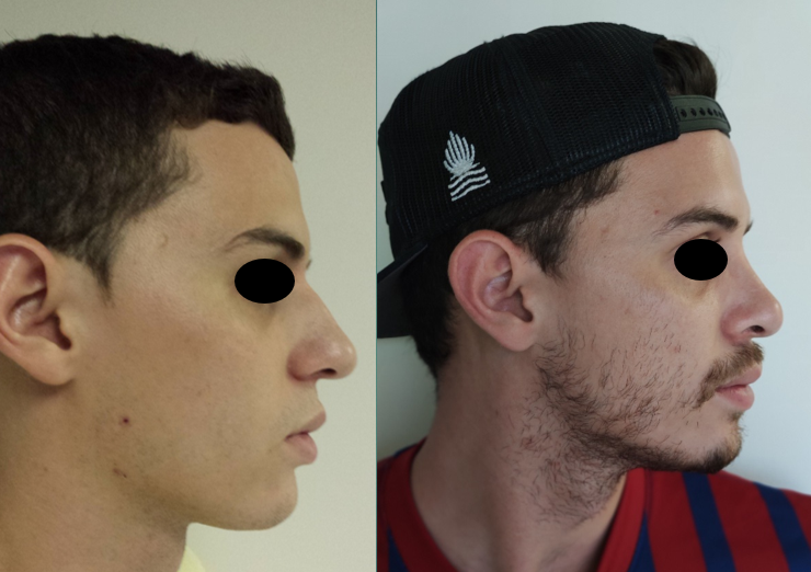 Resultado Rinoplastia 13