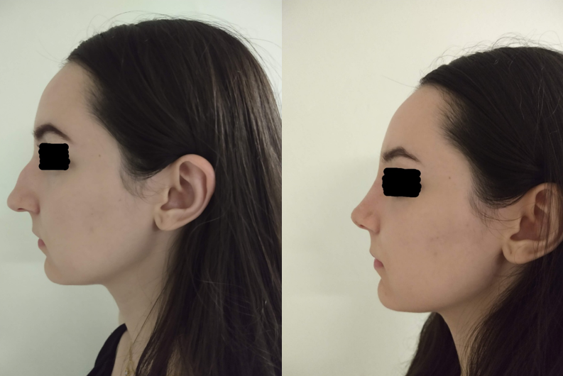 Resultado Rinoplastia 3