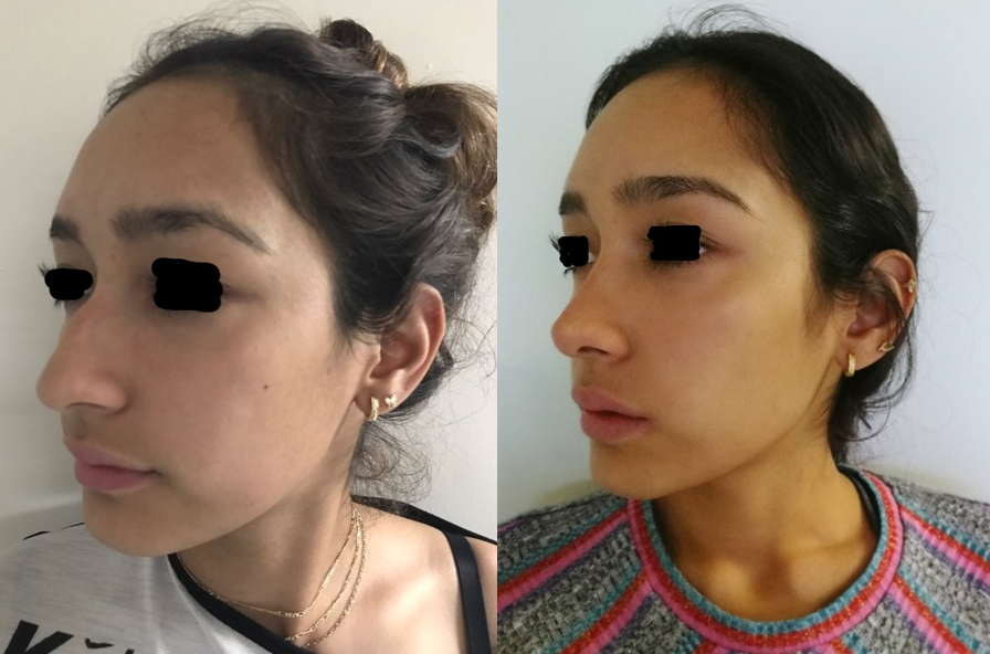Resultado Rinoplastia 5