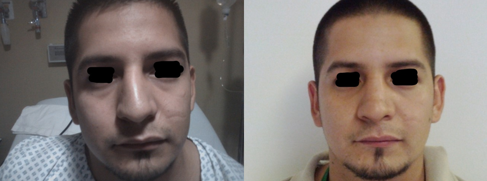 Resultado Rinoplastia 6