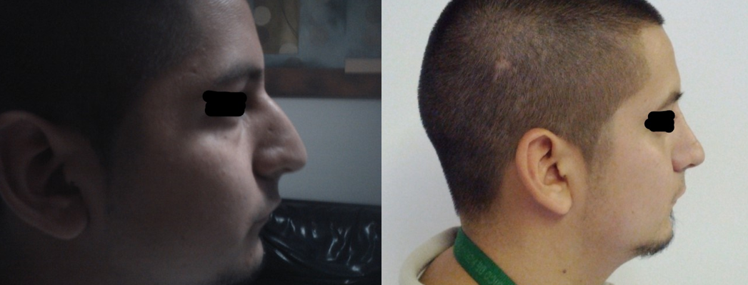 Resultado Rinoplastia 7