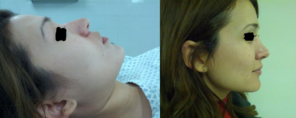 Resultado Rinoplastia 8