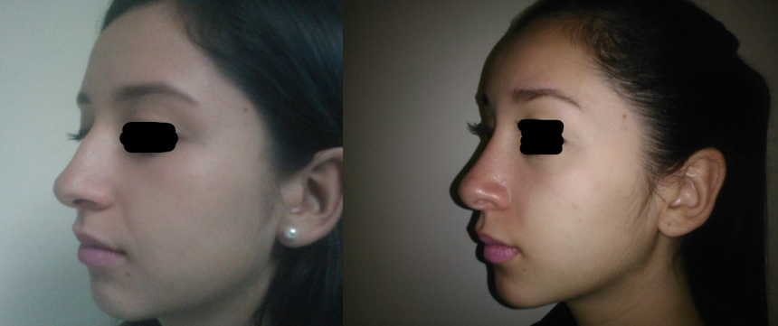 Resultado Rinoplastia 9