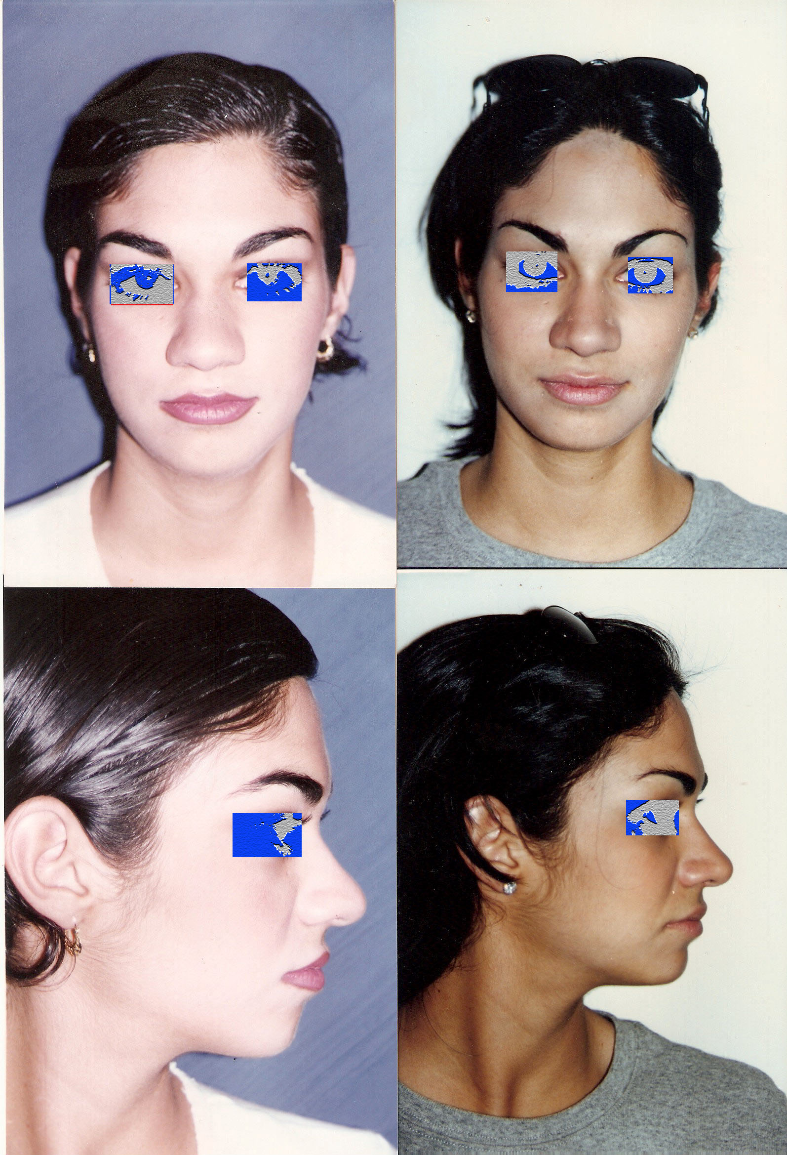 Resultado Rinoplastia