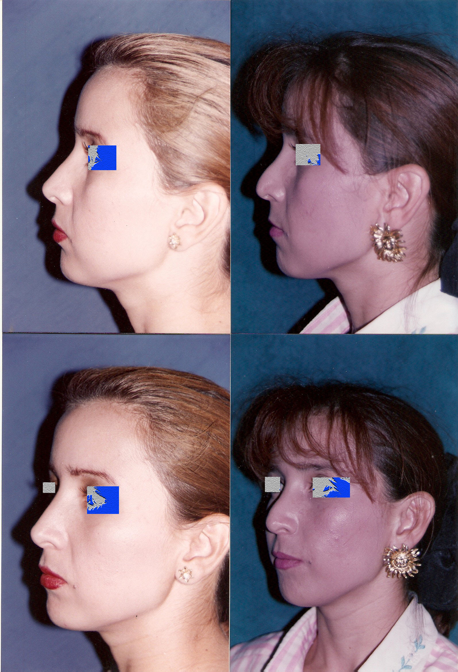 Resultado Rinoplastia