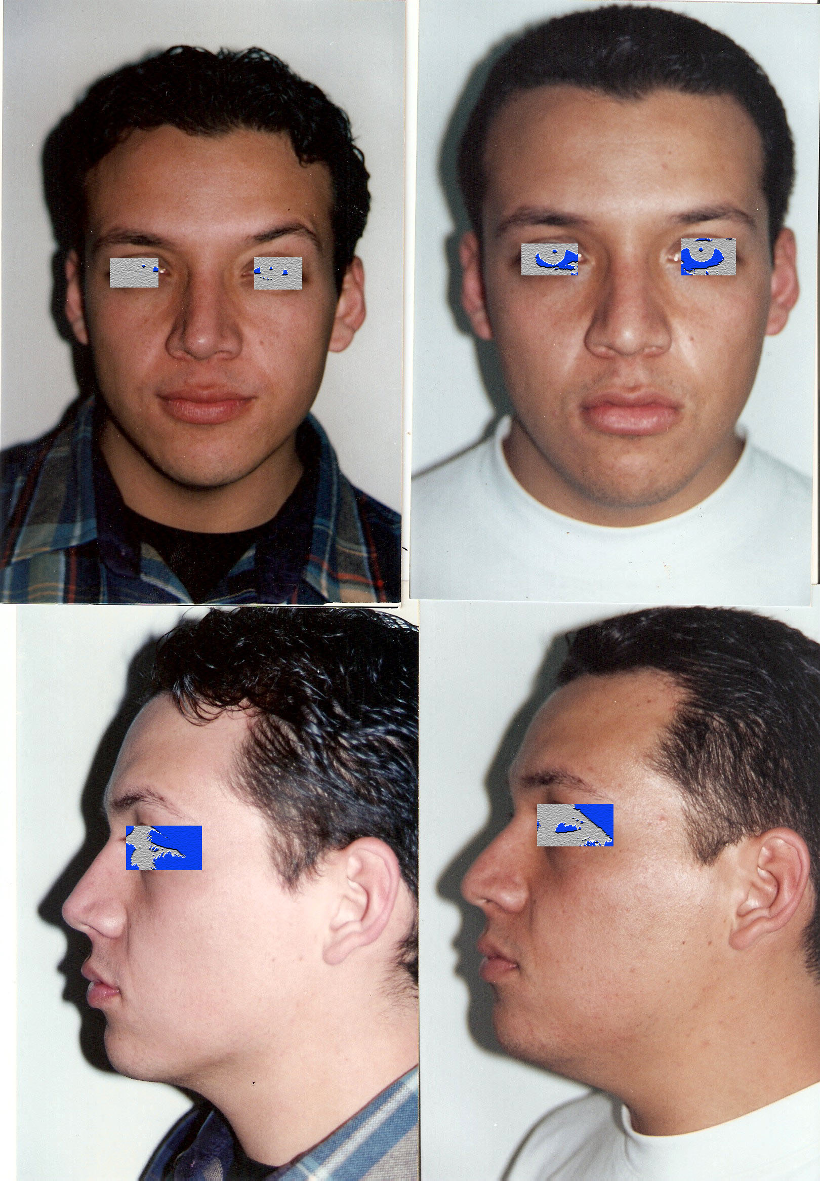 Resultado Rinoplastia